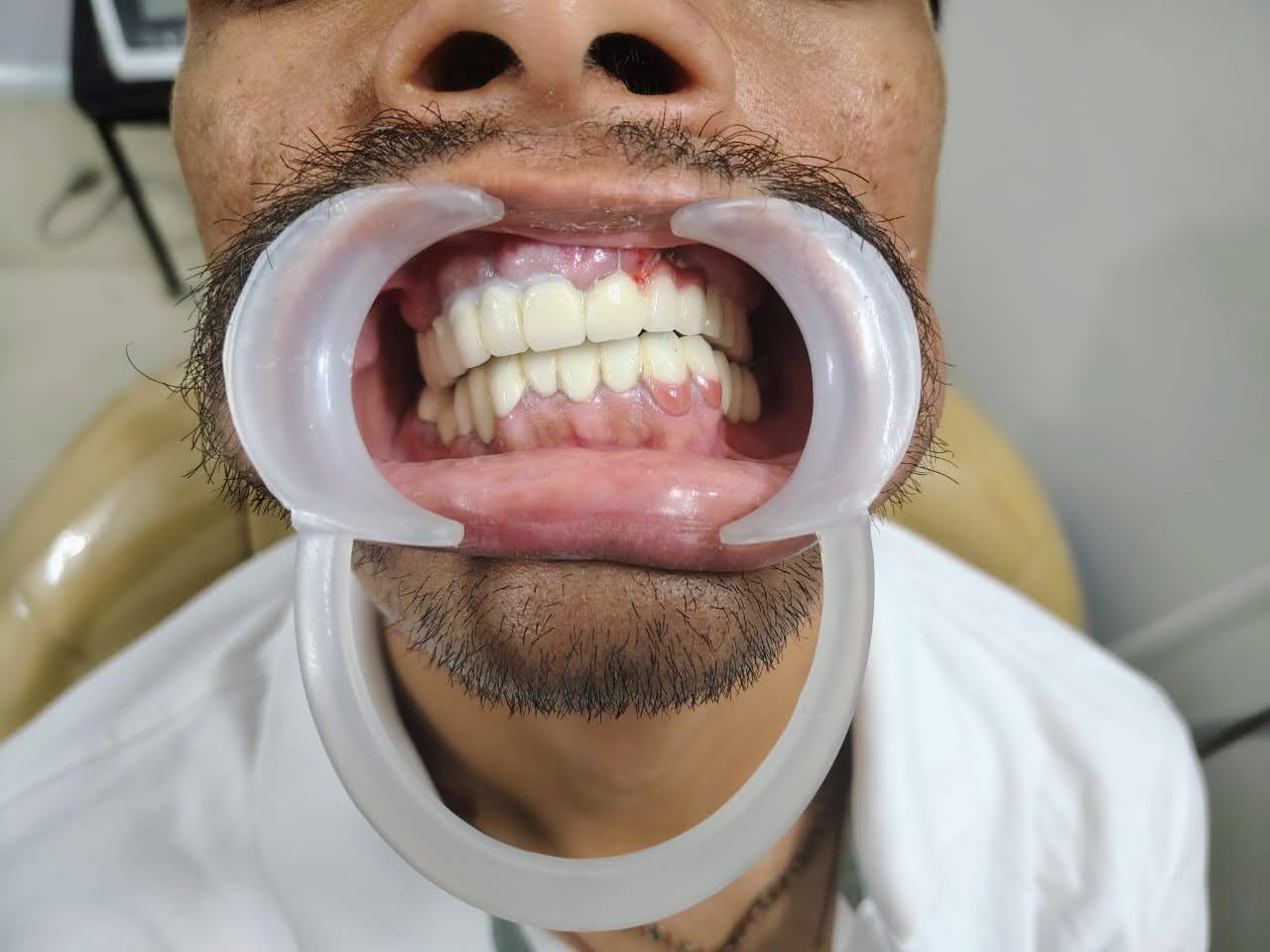 Mr Sagar Jadhav after fixed-smile treatment