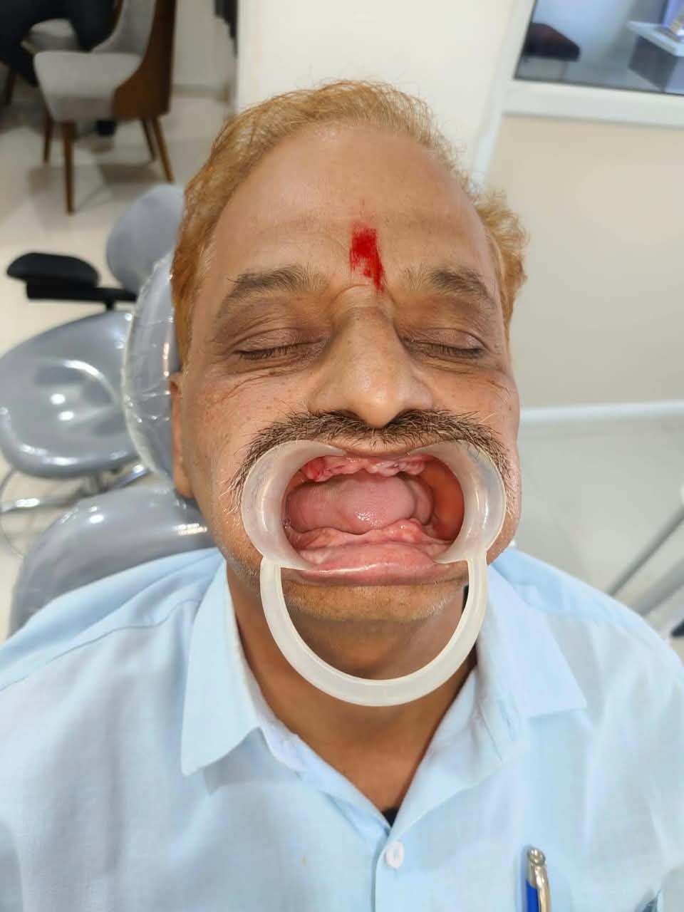 Murlidhar Visave · Jalgaon before fixed-smile treatment