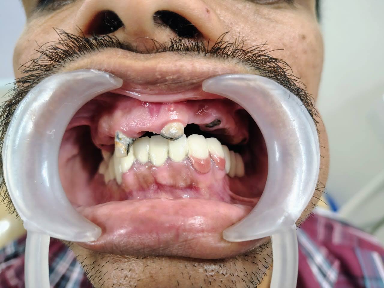 Mr Sagar Jadhav · Mahalunge, Pune before fixed-smile treatment