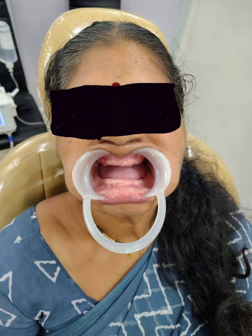 Mrs Mane · Manjari Khurd, Pune district before fixed-smile treatment